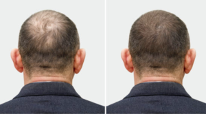 The Role of Hair Health Transplantation
